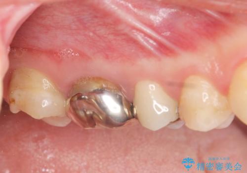 歯周外科を行い歯ぐきの整備を行うセラミック治療の症例 治療前