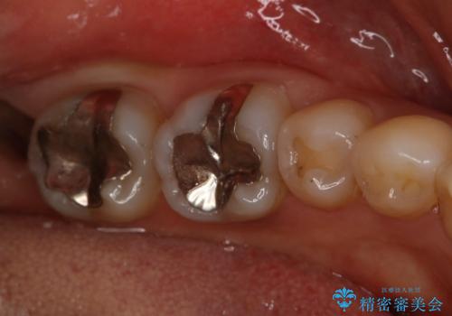 下の奥歯の銀歯を白くしたいの治療前