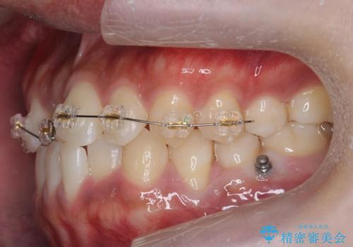 骨格性の受け口の矯正　部分ワイヤーで上の前歯を前に、　マウスピースで下の前歯を後ろに。の治療中