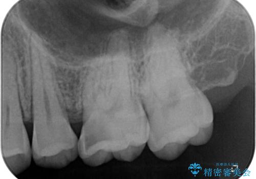 歯に穴が開いた　セラミックインレー修復の治療前