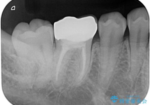 銀歯を白くしたい　オールセラミッククラウンの治療後