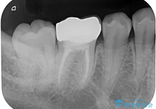 銀歯を白くしたい オールセラミッククラウンの治療後