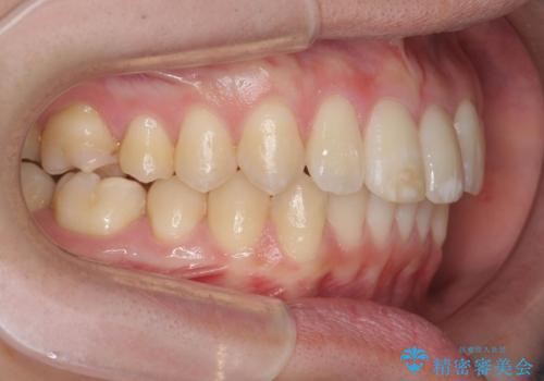 [ インビザライン ]  目立つすきっ歯をマウスピース矯正で改善の治療後