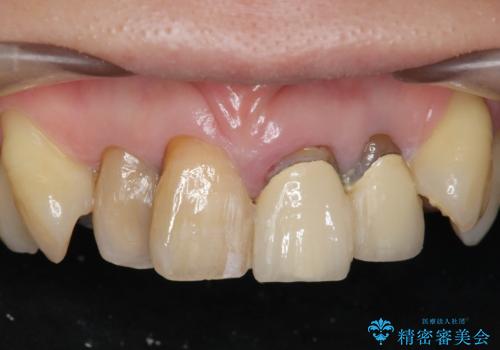 前歯の見た目をオールセラミッククラウンで改善の症例 治療前