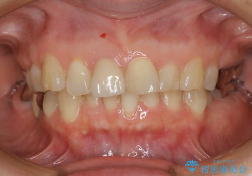 前歯が欠けたので治してほしいの症例 治療後