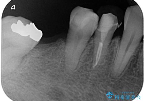 奥歯で食事をしたい インプラントとノンクラスプデンチャーによる治療の治療前