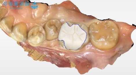 詰め物が外れた 一日でセラミック修復の治療中