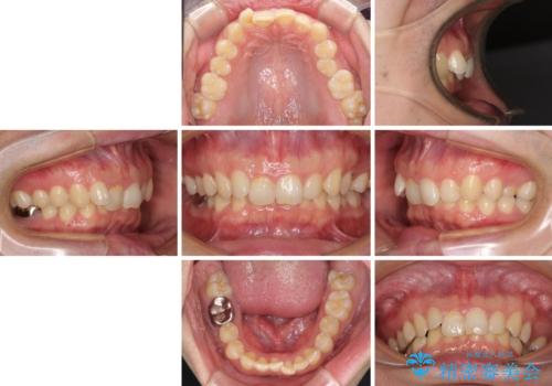 ねじれの強い前歯と奥歯　インビザラインでの矯正治療の治療前