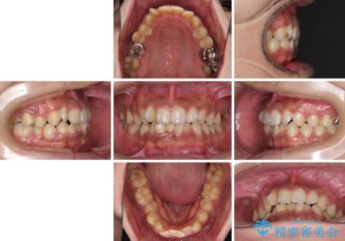 デコボコを治したい　インビザラインによる矯正治療の治療前