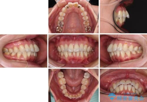 前方に飛び出した前歯　ワイヤー装置での抜歯矯正の治療前