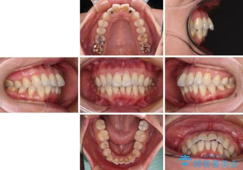 前方に飛び出した前歯 ワイヤー装置での抜歯矯正の治療前