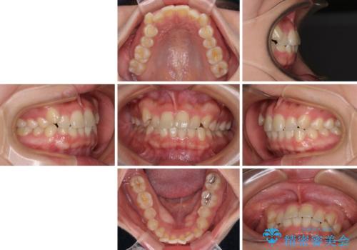 八重歯を治す　非抜歯のワイヤー矯正治療の治療前