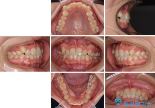 八重歯を治す 非抜歯のワイヤー矯正治療の治療前
