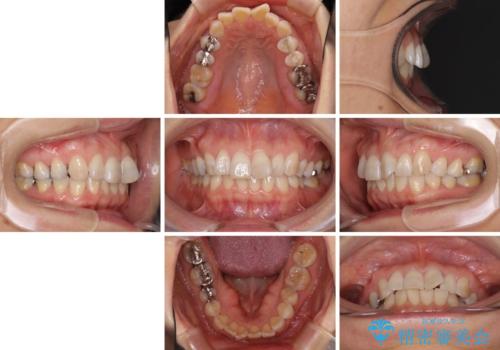 インビザラインが続けられない 忍耐のマウスピース矯正の治療前