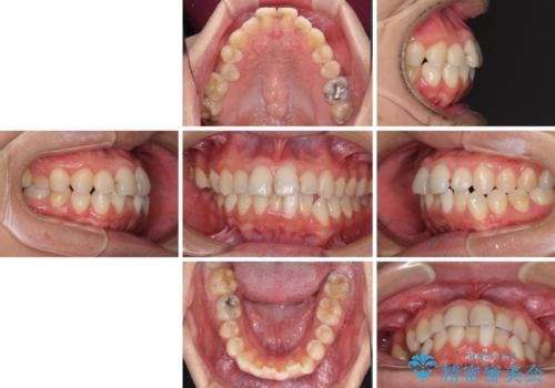顎が左右にずれた咬み合わせ ハーフリンガルの抜歯矯正の治療前