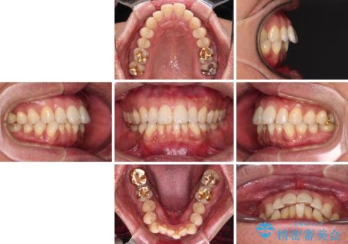 【モニター】口が閉じにくい　抜歯矯正でスッキリした口元にの治療前