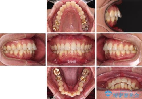 【モニター】口が閉じにくい 抜歯矯正でスッキリした口元にの治療前