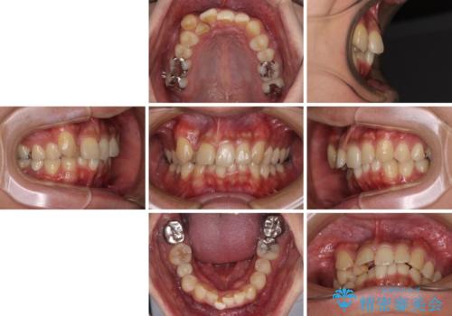 【モニター】八重歯と正中のずれた歯列　片顎抜歯のワイヤー矯正の治療前