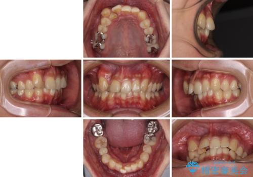 【モニター】八重歯と正中のずれた歯列 片顎抜歯のワイヤー矯正の治療前