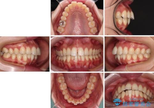 【モニター】飛び出した上顎前歯を抜歯矯正で引っ込める　ワイヤー装置の抜歯矯正治療の治療前