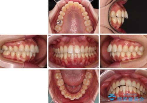 【モニター】飛び出した上顎前歯を抜歯矯正で引っ込める ワイヤー装置の抜歯矯正治療の治療前