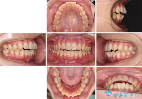 舌の突出癖による開咬と前歯の突出 インビザライン矯正治療の治療前