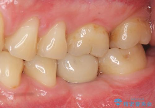 虫歯の再発による抜歯後のインプラント治療の治療後