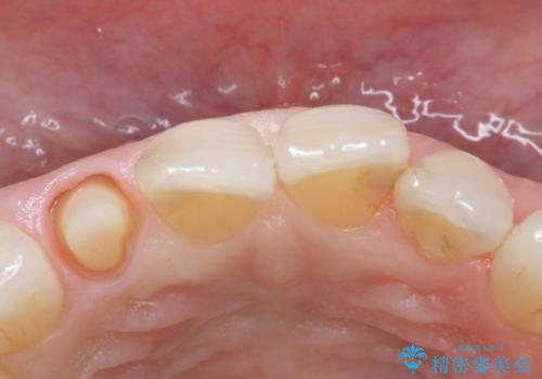 前歯が取れてしまった ジルコニアクラウンでの修復の治療中