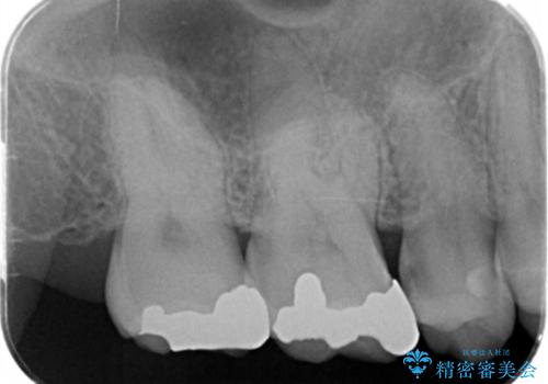 メタルフリー治療 銀歯を全て除去したいの治療前