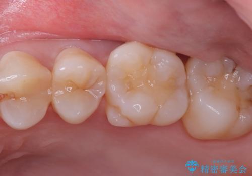 【セラミックインレー】歯が欠けたので治したいの治療前