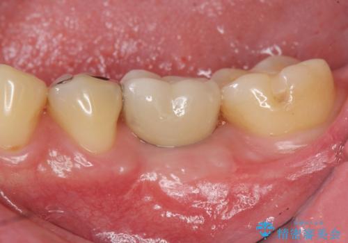 虫歯の再発による抜歯後のインプラント治療の症例 治療後