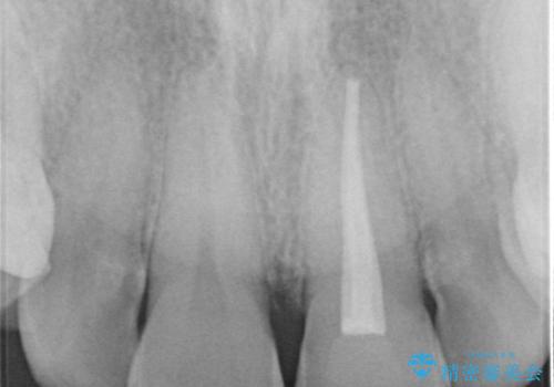 変色した前歯 ジルコニアクラウンでの修復の治療前