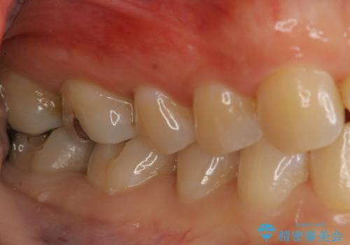 奥歯を綺麗にしたいの治療中