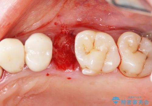 重度歯周病 抜歯後のブリッジ治療の治療中