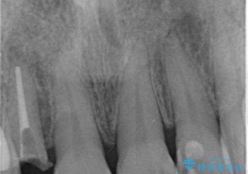前歯が取れてしまった ジルコニアクラウンでの修復の治療前