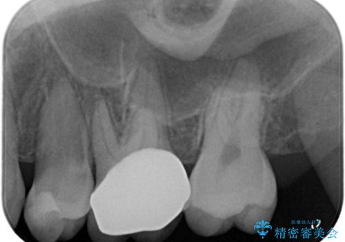 【VPT/歯髄温存療法・オールセラミッククラウン】虫歯が深く神経まで達していたが健康な神経は残す治療!の治療後