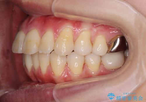 捻れた奥歯 突き出た前歯を治したいの治療後