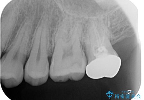 銀歯を無くしたい。の治療前