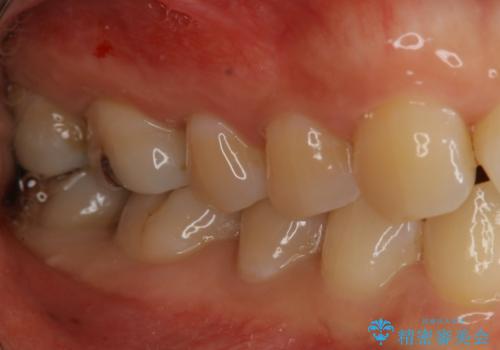 奥歯を綺麗にしたいの治療前