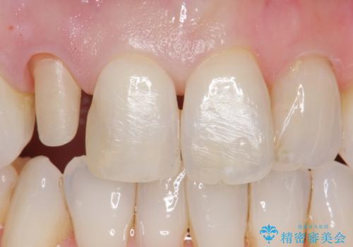 前歯が取れてしまった ジルコニアクラウンでの修復の治療中