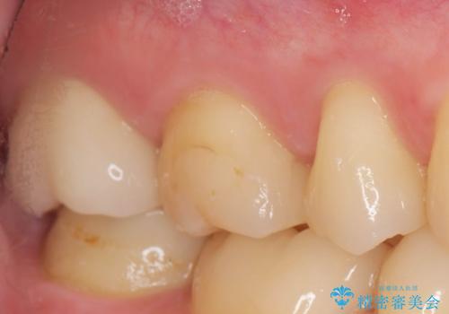 メタルフリー治療 銀歯を全て除去したいの治療後