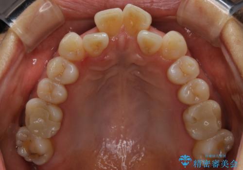 前歯の反対咬合、奥に引っ込んでしまっている歯をインビザラインで治療するの治療前