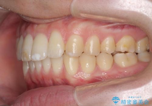 [ インビザライン ]  目立つすきっ歯をマウスピース矯正で改善の治療後