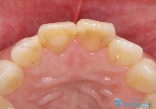 リアルな歯の色調にこだわるオールセラミッククラウン治療の治療前