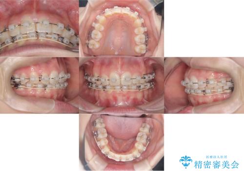 【ワイヤー矯正!】歯のでこぼこと捻じれを治したい!の治療中