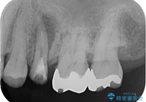 歯茎が腫れる インプラントでの治療の治療前