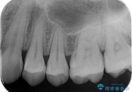 【セラミックインレー】歯が欠けたので治したいの治療前