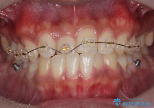骨格性の受け口の矯正　部分ワイヤーで上の前歯を前に、　マウスピースで下の前歯を後ろに。の治療中