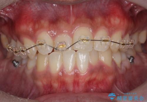 骨格性の受け口の矯正 部分ワイヤーで上の前歯を前に、 マウスピースで下の前歯を後ろに。の治療中