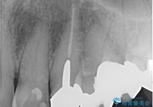 前歯が気になる。ブリッジによる治療。の治療前